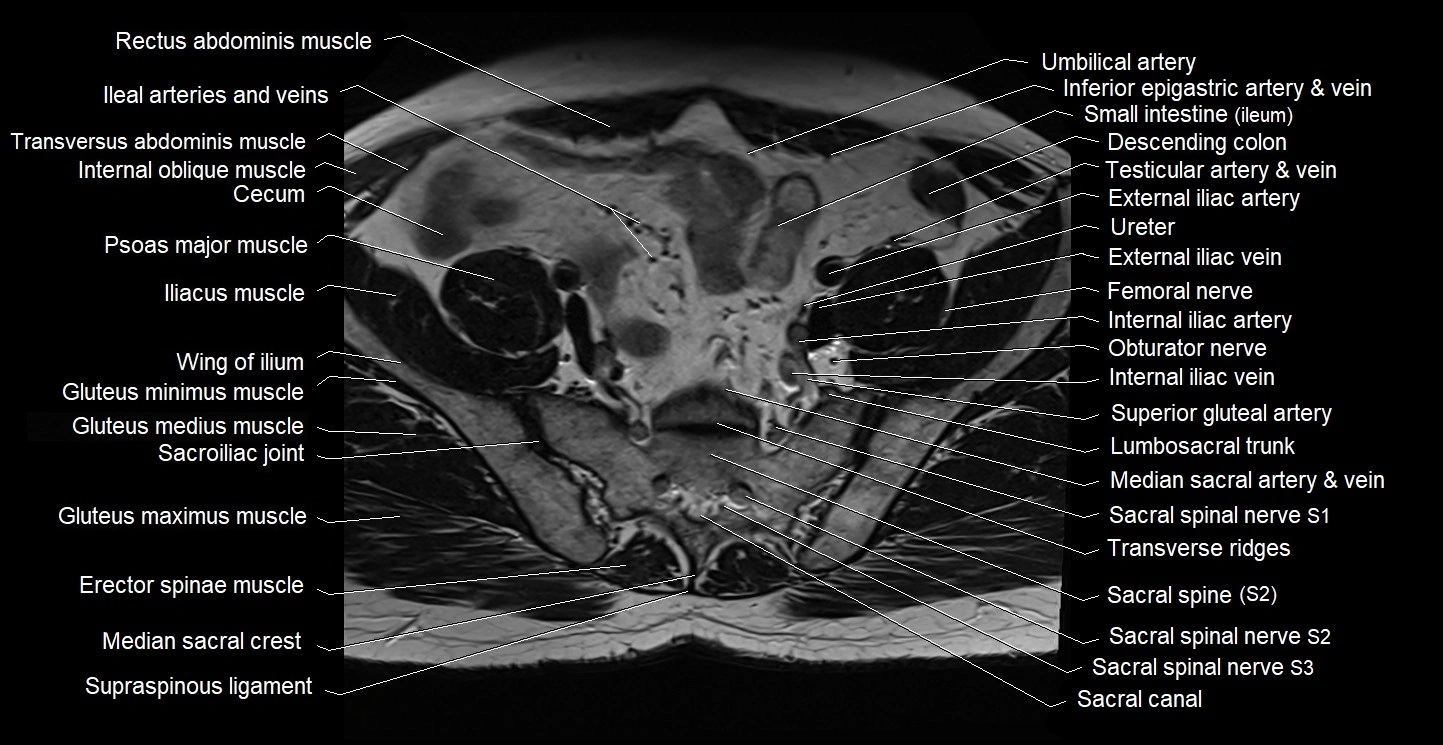 Male pelvis axial cross sectional anatomy image 4.webp